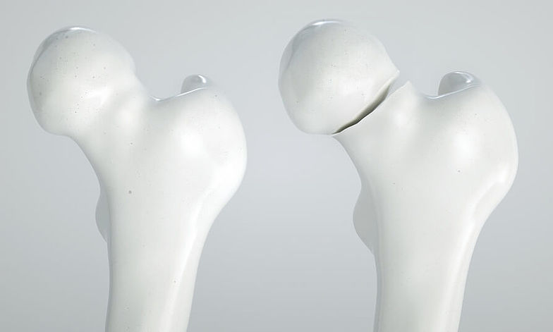 Darstellung zweier Oberschenkel-Modelle. Ein Modell zeigt einen gesunden Oberschenkelknochen. Das andere Modell zeigt einen Bruch des Oberhalsknochens.